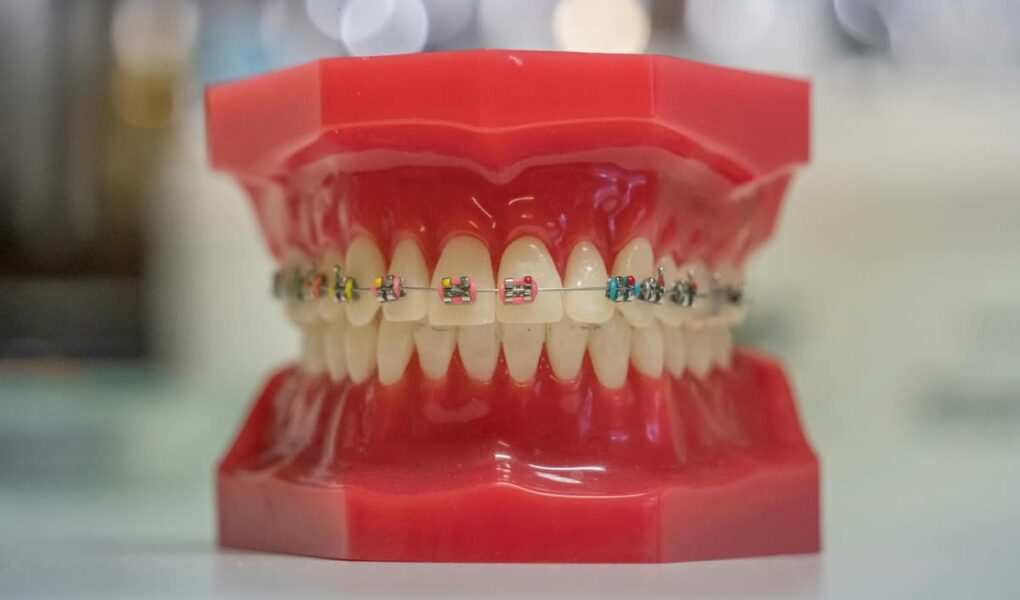 Aparaty ortodontyczne w Gdańsku – czym się różnią i jak wybrać odpowiedni?